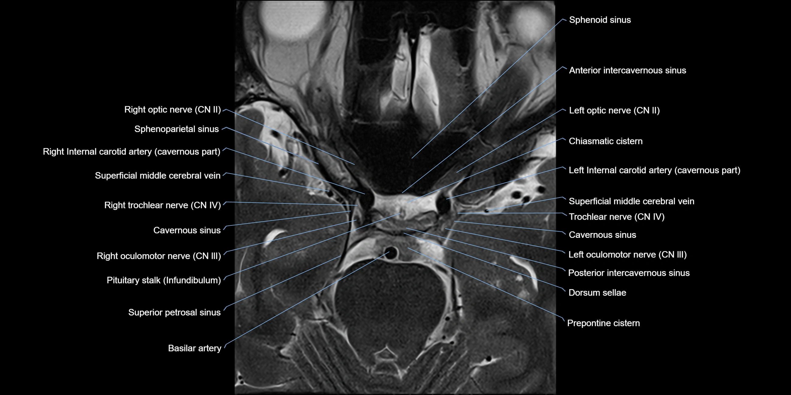 MRI cavernous sinus axial cross sectional 3T anatomy image-img-11001-00013.webp